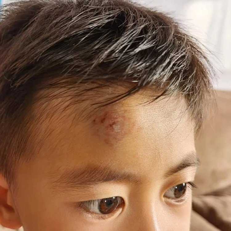 Traditional Formula Ziyun Ointment (2 tubes): For insect bites, burns, scalds, sunburns, baby eczema, diaper rash, minor injuries, and acne. Natural and additive-free, safe for mothers and babies.