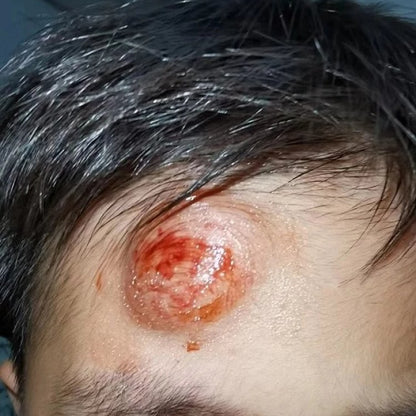 Traditional Formula Ziyun Ointment (2 tubes): For insect bites, burns, scalds, sunburns, baby eczema, diaper rash, minor injuries, and acne.  Natural and additive-free, safe for mothers and babies.